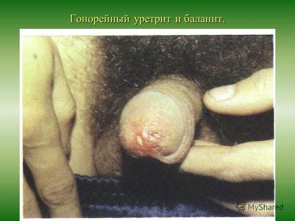 Можно Ли Заразиться Венерическими Инфекциями Через Миньет можно ли заразиться венерическими инфекциями через миньет