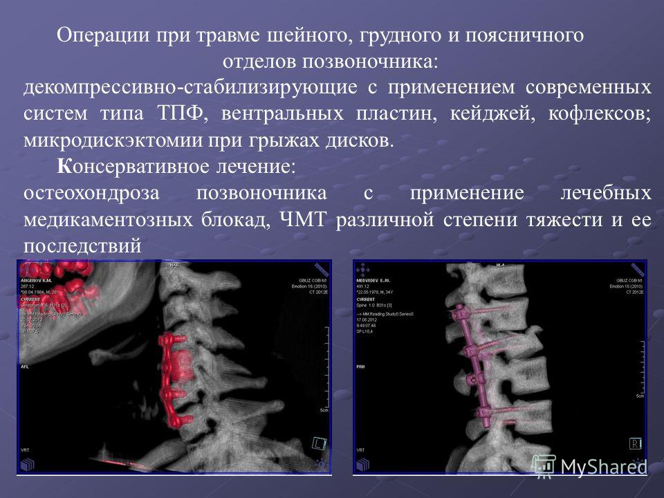 Остеохондроз головные боли народное лечение Остеохондроз головные боли народное лечение