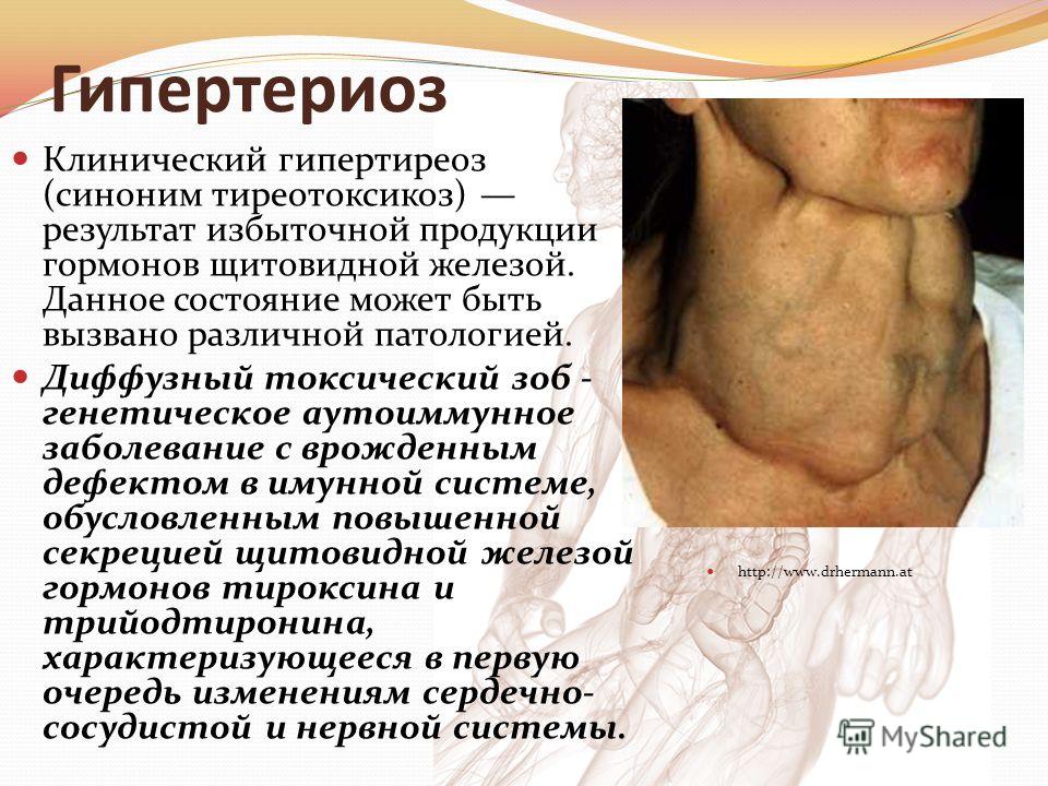 Как можно лечить гипертиреоз щитовидной железы Как можно лечить гипертиреоз щитовидной железы