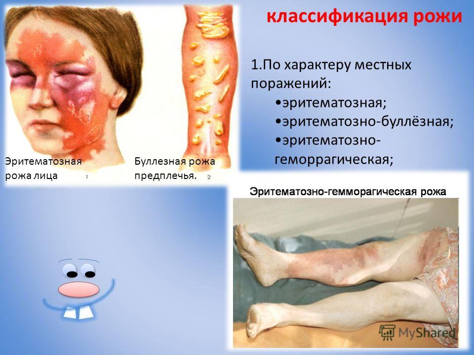 Что Такое Рожа Заболевание Фото Что Такое Рожа Заболевание Фото