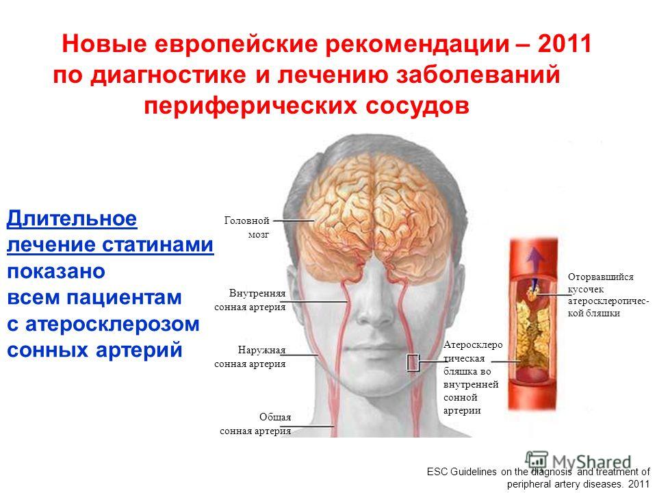 инсульт статины инсульт статины