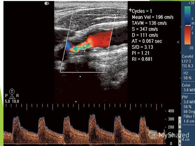 Как делают узи сосудов головы и шеи показать фото