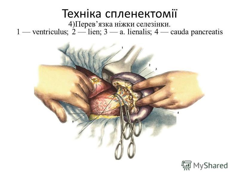 Техніка спленектомії 4)Перевязка ніжки селезінки. 1 ventriculus; 2 lien; 3 a. lienalis; 4 cauda pancreatis