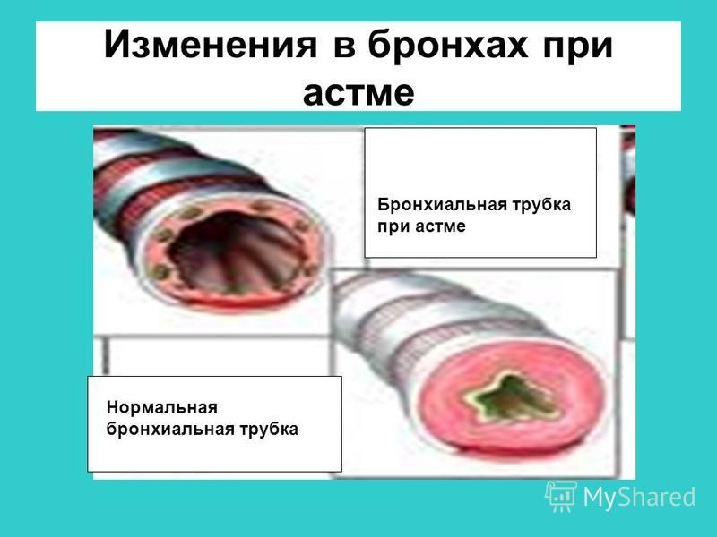 Изменения в бронхах при астме Бронхиальная трубка при астме Нормальная бронхиальная трубка