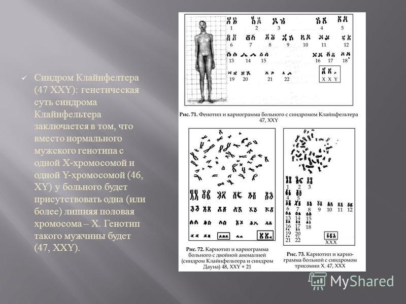 Синдром Клайнфелтера (47 XXY): генетическая суть синдрома Клайнфельтера заключается в том, что вместо нормального мужского генотипа с одной X- хромосомой и одной Y- хромосомой (46, XY) у больного будет присутствовать одна ( или более ) лишняя половая