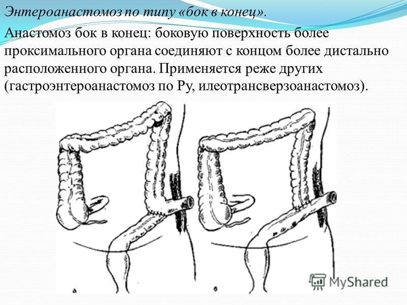 Энтероанастомоз по типу «бок в конец». Анастомоз бок в конец: боковую поверхность более проксимального органа соединяют с концом более дистально расположенного органа. Применяется реже других (гастроэнтероанастомоз по Ру, илеотрансверзоанастомоз).