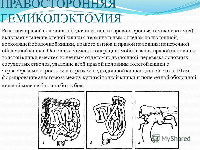 Диета После Гемиколэктомии