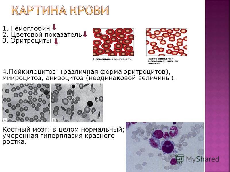 1. Гемоглобин 2. Цветовой показатель 3. Эритроциты 4. Пойкилоцитоз (различная форма эритроцитов), микроцитоз, анизоцитоз (неодинаковой величины). Костный мозг: в целом нормальный; умеренная гиперплазия красного ростка.