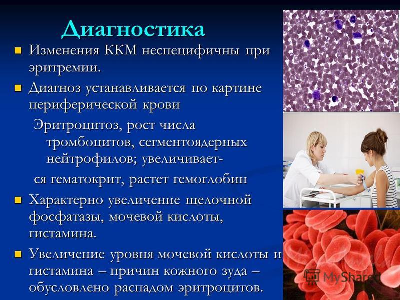 Диагностика Изменения ККМ неспецифичны при эритремии. Изменения ККМ неспецифичны при эритремии. Диагноз устанавливается по картине периферической крови Диагноз устанавливается по картине периферической крови Эритроцитоз, рост числа тромбоцитов, сегме