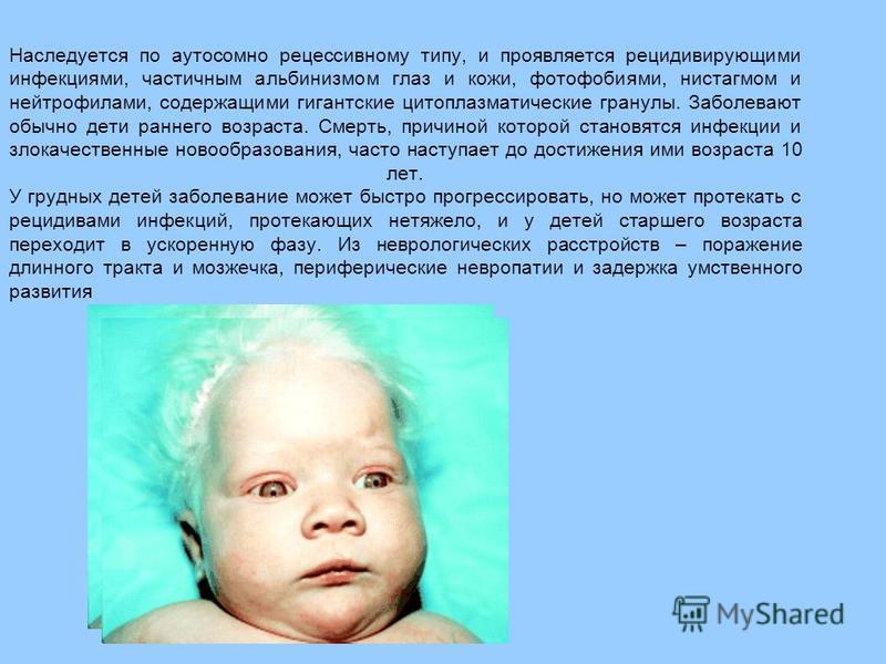 Наследуется по аутосомно рецессивному типу, и проявляется рецидивирующими инфекциями, частичным альбинизмом глаз и кожи, фотофобиями, нистагмом и нейтрофилами, содержащими гигантские цитоплазматические гранулы. Заболевают обычно дети раннего возраста