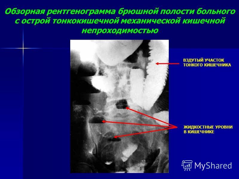 Обзорная рентгенограмма брюшной полости больного с острой тонкокишечной механической кишечной непроходимостью ВЗДУТЫЙ УЧАСТОК ТОНКОГО КИШЕЧНИКА ЖИДКОСТНЫЕ УРОВНИ В КИШЕЧНИКЕ