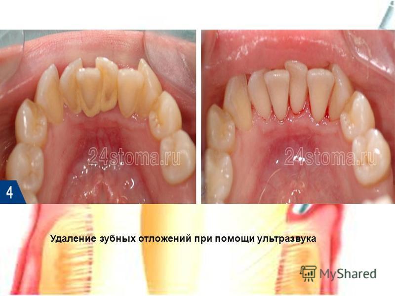 Удаление зубных отложений при помощи ультразвука
