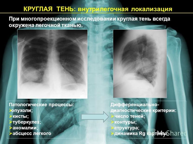 Рентгенологическая картина при абсцессе