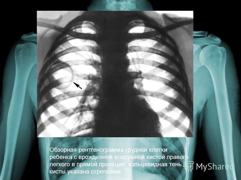 Обзорная рентгенограмма грудной клетки ребенка с врожденной воздушной кистой правого легкого в прямой проекции: кольцевидная тень кисты указана стрелками.