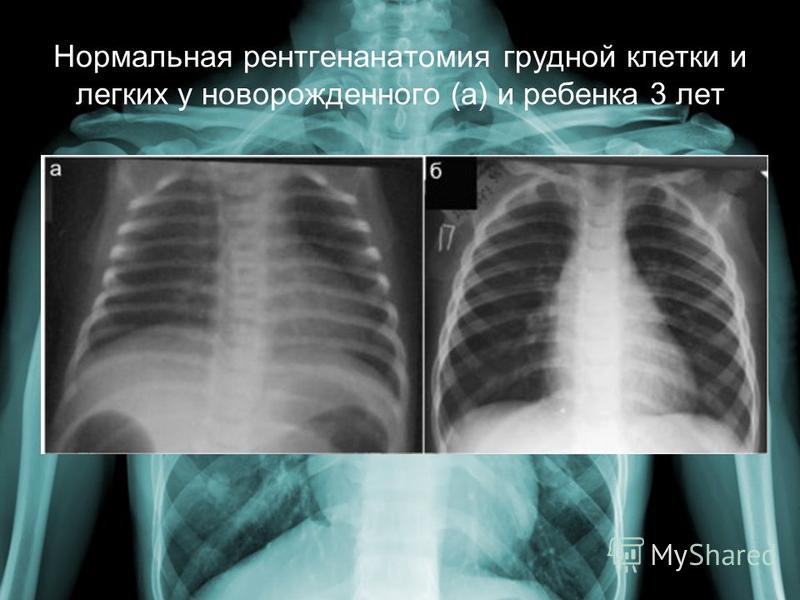Укладка при рентгене легких Укладка при рентгене легких