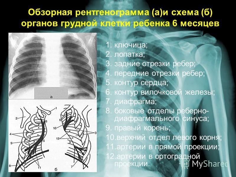 Обзорная рентгенограмма (а)и схема (б) органов грудной клетки ребенка 6 месяцев 1.ключица; 2.лопатка; 3. задние отрезки ребер; 4. передние отрезки ребер; 5. контур сердца; 6. контур вилочковой железы; 7.диафрагма; 8. боковые отделы реберно- диафрагма