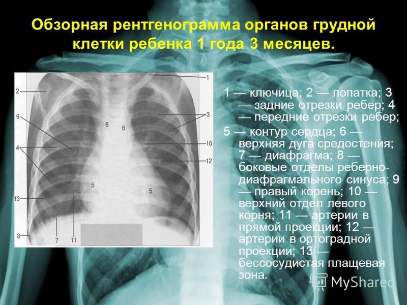Обзорная рентгенограмма органов грудной клетки ребенка 1 года 3 месяцев. 1 ключица; 2 лопатка; 3 задние отрезки ребер; 4 передние отрезки ребер; 5 контур сердца; 6 верхняя дуга средостения; 7 диафрагма; 8 боковые отделы реберно- диафрагмального синус