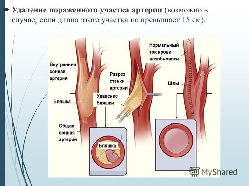Удаление пораженного участка артерии (возможно в случае, если длина этого участка не превышает 15 см).