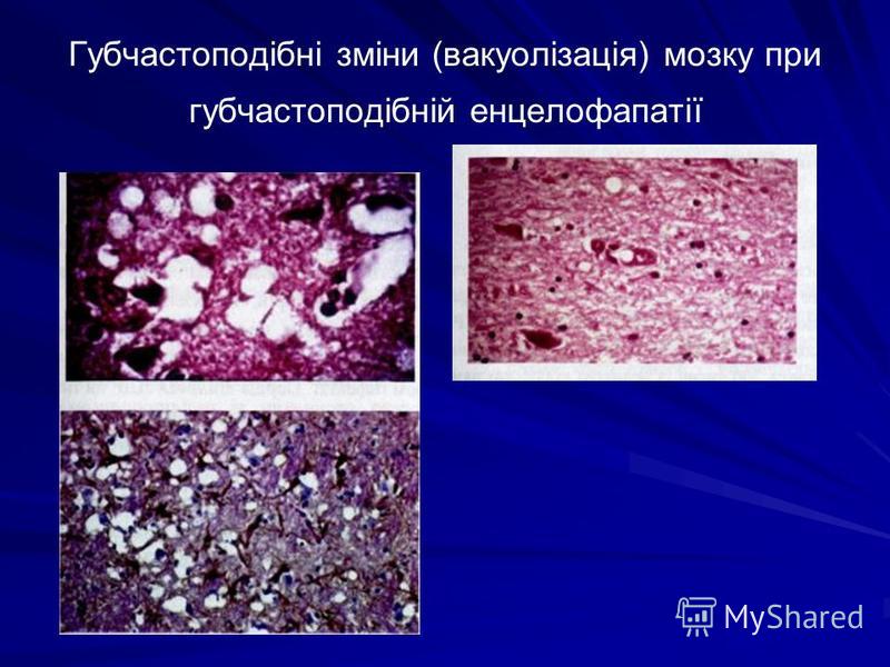 Губчастоподібні зміни (вакуолізація) мозку при губчастоподібній енцелофапатії