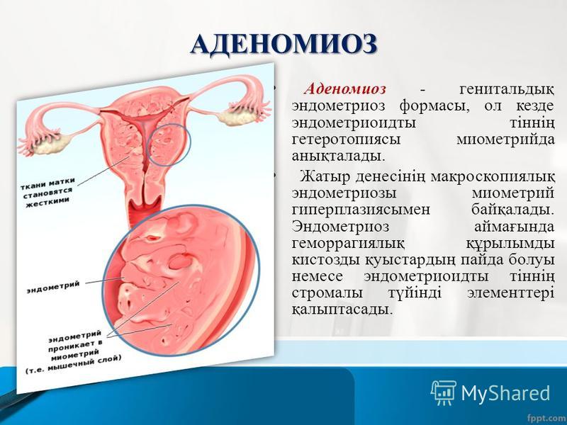 АДЕНОМИОЗ Аденомиоз - генитальдық эндометриоз форматы, ол кезде эндометриоидты тіннің гетеротопиясы миометрий да анықталады. Жатыр денесінің макроскопиялық эндометриозы миометрий гиперплазиясымен байқалады. Эндометриоз аймағында геморрагиялық құрылым