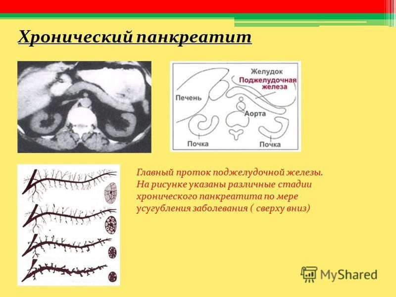 Хронический панкреатит Главный проток поджелудочной железы. На рисунке указаны различные стадии хронического панкреатита по мере усугубления заболевания ( сверху вниз)