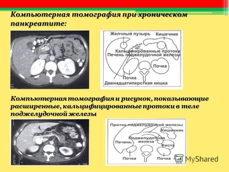 Компьютерная томография при хроническом панкреатите: Компьютерная томография и рисунок, показывающие расширенные, кальцифицированные протоки в теле поджелудочной железы