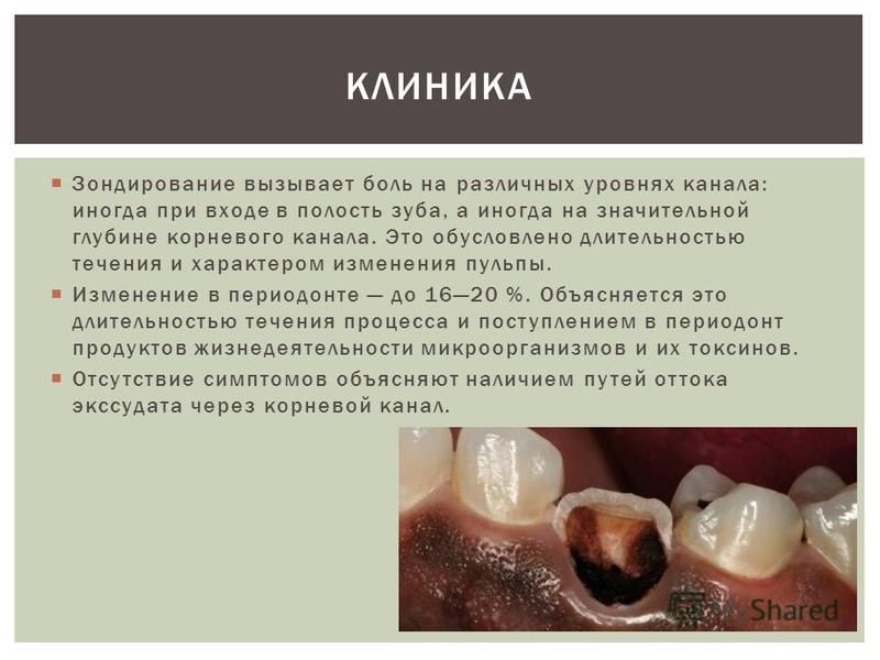 Зондирование вызывает боль на различных уровнях канала: иногда при входе в полость зуба, а иногда на значительной глубине корневого канала. Это обусловлено длительностью течения и характером изменения пульпы. Изменение в периодонте до 1620 %. Объясня