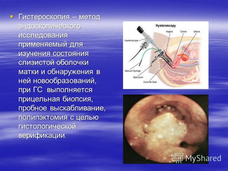 Гистероскопия – метод эндоскопического исследования применяемый для изучения состояния слизистой оболочки матки и обнаружения в ней новообразований, при ГС выполняется прицельная биопсия, пробное выскабливание, полипэктомия с целью гистологической ве