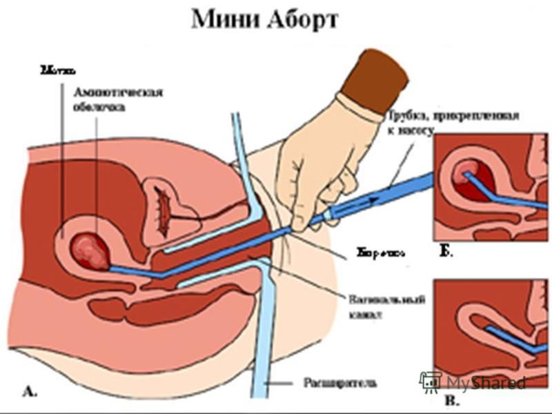 Медикаментозний аборт - ( Фармакологічний ) - метод переривання вагітності на ранньому терміні за допомогою спеціальних лікарських препаратів. Міні - аборт - це метод переривання небажаної вагітності, що проводиться на ранніх термінах ( до 7 тижнів )