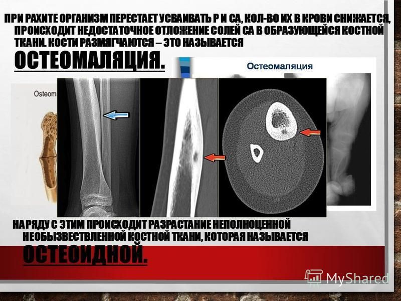 Костные разрастания в коленном суставе. Лечение После Эндопротезирования Коленного Сустава — Buy-artox.ru Остеоартроз коленного сустава: симптомы и лечение, код по МКБ-10. Растяжение связок коленного сустава. Способы лечения