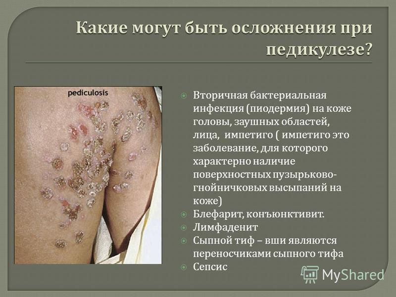 Вторичная бактериальная инфекция ( пиодермия ) на коже головы, заушных областей, лица, импетиго ( импетиго это заболевание, для которого характерно наличие поверхностных пузырьково - гнойничковых высыпаний на коже ) Блефарит, конъюнктивит. Лимфаденит