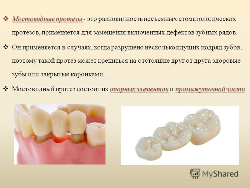 Мостовидные протезы Мостовидные протезы - это разновидность несъемных стоматологических протезов, применяется для замещения включенных дефектов зубных рядов. Он применяется в случаях, когда разрушено несколько идущих подряд зубов, поэтому такой проте