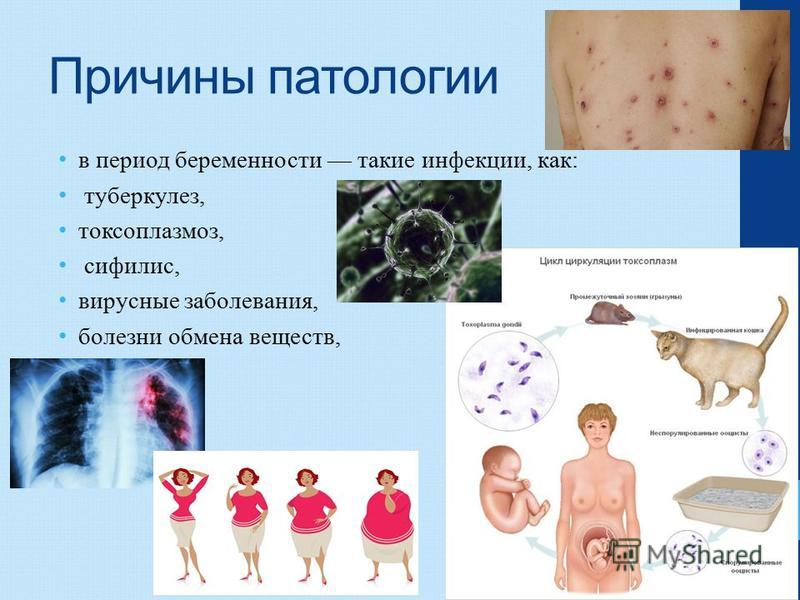 Причины патологии в период беременности такие инфекции, как : туберкулез, токсоплазмоз, сифилис, вирусные заболевания, болезни обмена веществ,
