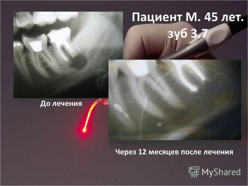 Пациент М. 45 лет. зуб 3.7 До лечения Через 12 месяцев после лечения
