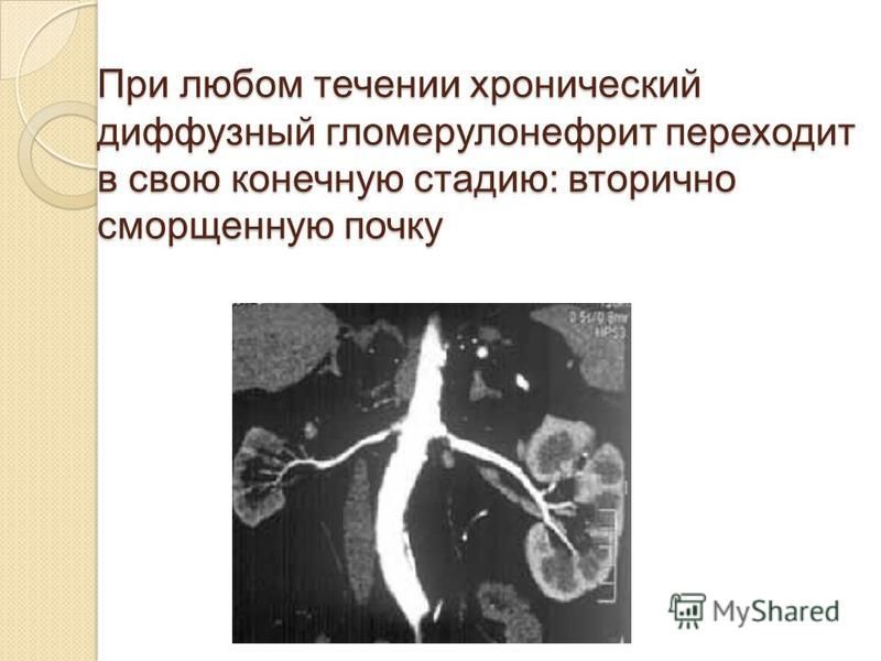При любом течении хронический диффузный гломерулонефрит переходит в свою конечную стадию: вторично сморщенную почку