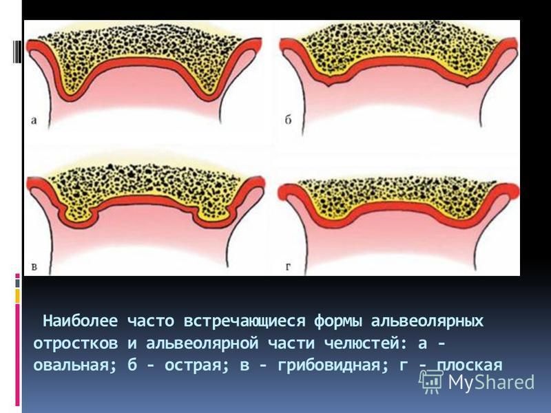 Наиболее часто встречающиеся формы альвеолярных отростков и альвеолярной части челюстей: а - овальная; б - острая; в - грибовидная; г - плоская