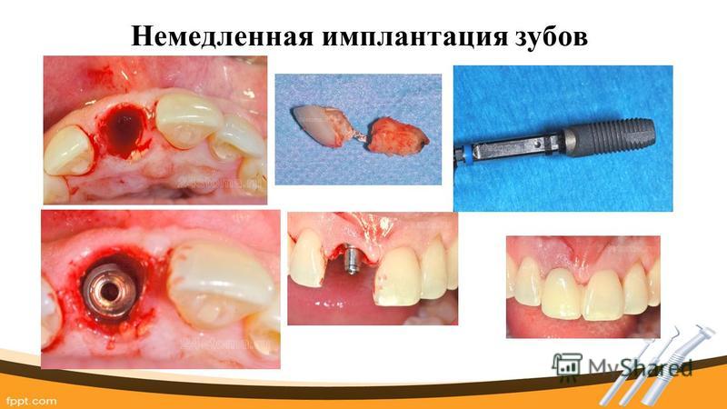 Немедленная имплантация зубов