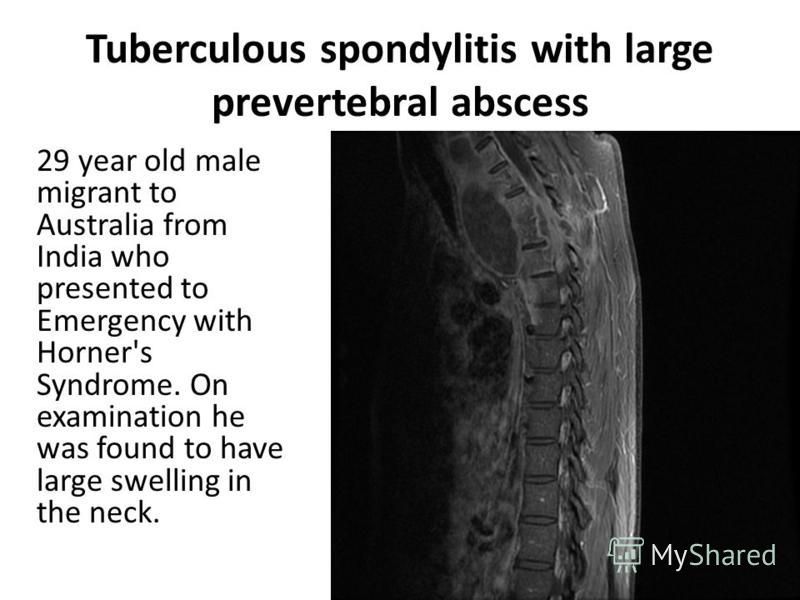 Tuberculous spondylitis with large prevertebral abscess 29 year old male migrant to Australia from India who presented to Emergency with Horner's Syndrome. On examination he was found to have large swelling in the neck.