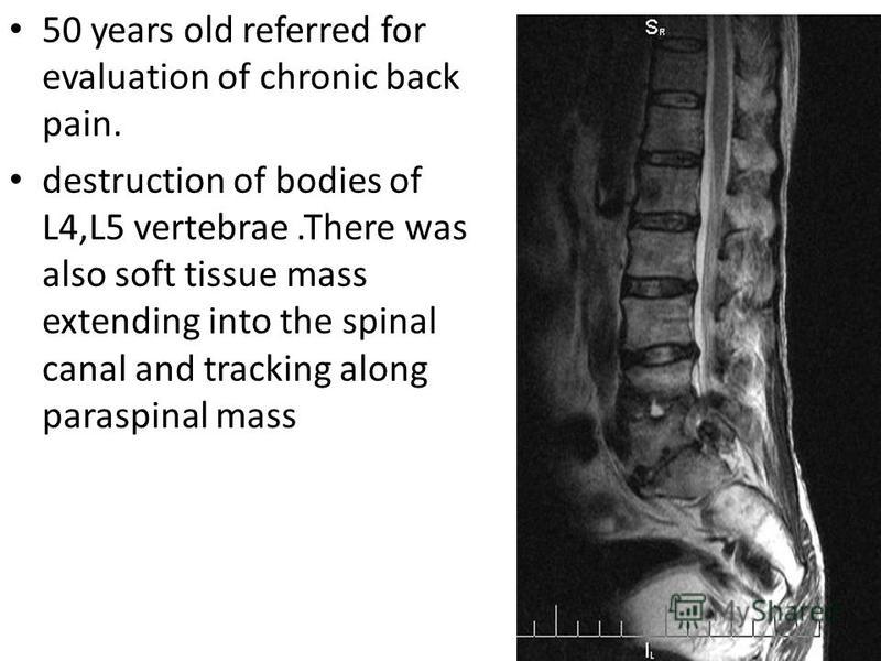 50 years old referred for evaluation of chronic back pain. destruction of bodies of L4,L5 vertebrae.There was also soft tissue mass extending into the spinal canal and tracking along paraspinal mass