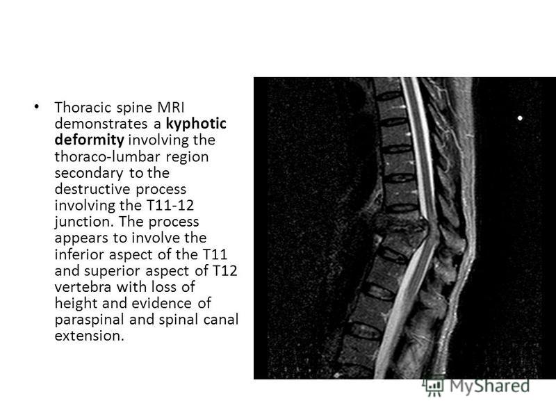 Thoracic spine MRI demonstrates a kyphotic deformity involving the thoraco-lumbar region secondary to the destructive process involving the T11-12 junction. The process appears to involve the inferior aspect of the T11 and superior aspect of T12 vert