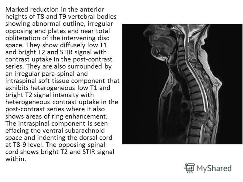 Marked reduction in the anterior heights of T8 and T9 vertebral bodies showing abnormal outline, irregular opposing end plates and near total obliteration of the intervening disc space. They show diffusely low T1 and bright T2 and STIR signal with co