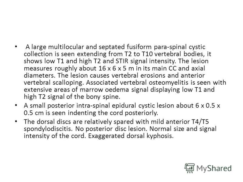 A large multilocular and septated fusiform para-spinal cystic collection is seen extending from T2 to T10 vertebral bodies, it shows low T1 and high T2 and STIR signal intensity. The lesion measures roughly about 16 x 6 x 5 m in its main CC and axial