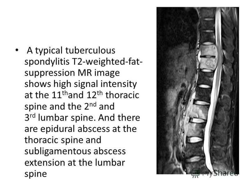 A typical tuberculous spondylitis T2-weighted-fat- suppression MR image shows high signal intensity at the 11 th and 12 th thoracic spine and the 2 nd and 3 rd lumbar spine. And there are epidural abscess at the thoracic spine and subligamentous absc