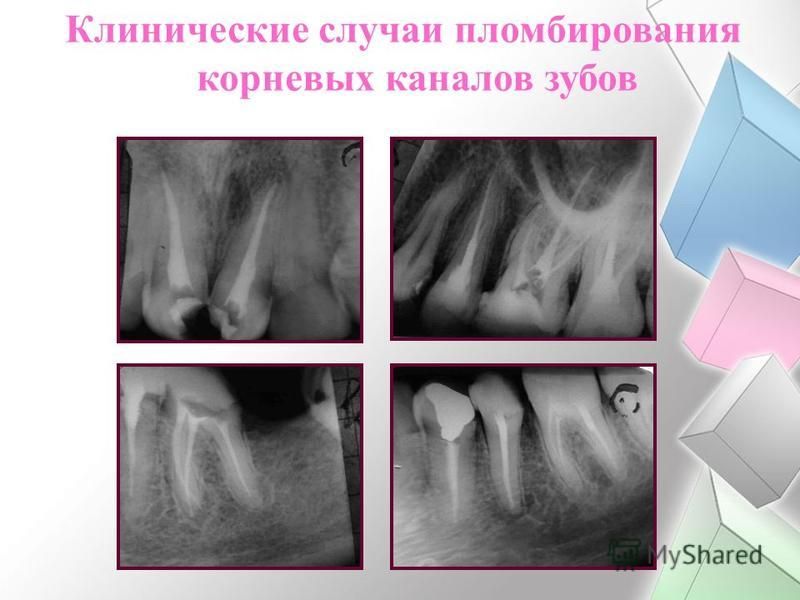 Клинические случаи пломбирования корневых каналов зубов