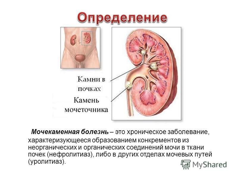 Можно Ли Заниматься Сексом При Мочекаменной Болезни