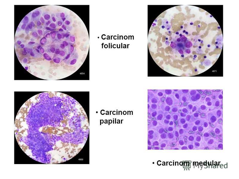 Carcinom folicular Carcinom papilar Carcinom medular