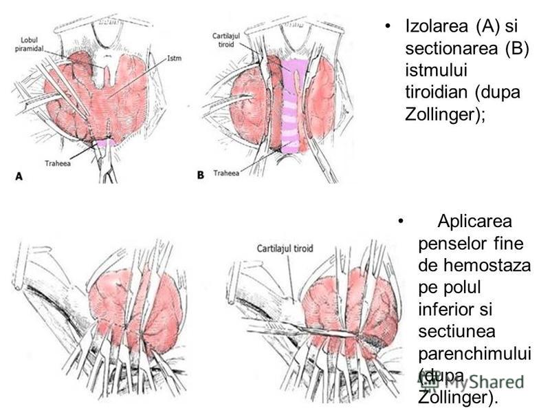 Izolarea (A) si sectionarea (B) istmului tiroidian (dupa Zollinger); Aplicarea penselor fine de hemostaza pe polul inferior si sectiunea parenchimului (dupa Zollinger).