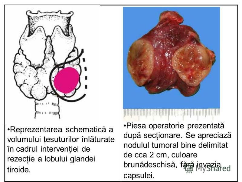 Reprezentarea schematică a volumului ţesuturilor înlăturate în cadrul intervenţiei de rezecţie a lobului glandei tiroide. Piesa operatorie prezentată după secţionare. Se apreciază nodulul tumoral bine delimitat de cca 2 cm, culoare brunădeschisă, făr