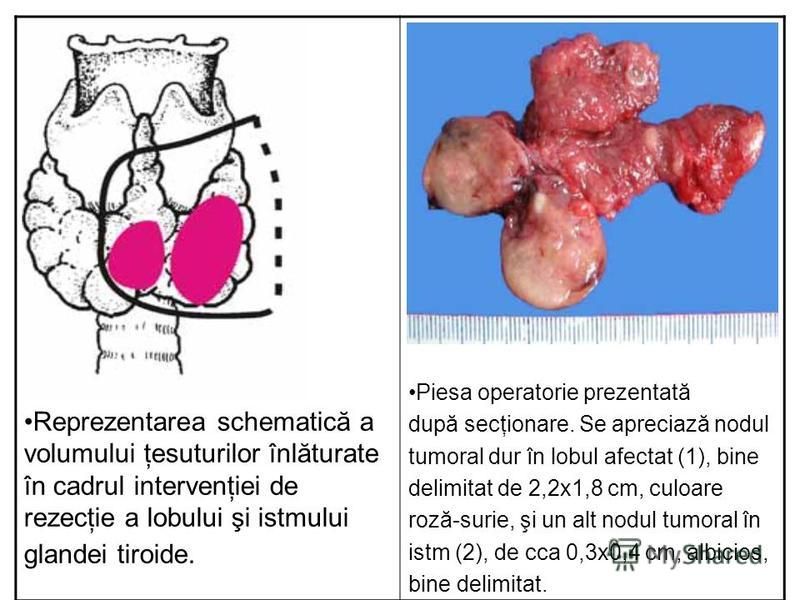 Reprezentarea schematică a volumului ţesuturilor înlăturate în cadrul intervenţiei de rezecţie a lobului şi istmului glandei tiroide. Piesa operatorie prezentată după secţionare. Se apreciază nodul tumoral dur în lobul afectat (1), bine delimitat de 