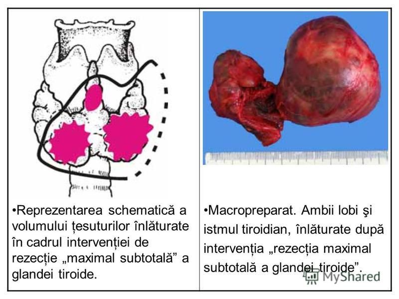 Reprezentarea schematică a volumului ţesuturilor înlăturate în cadrul intervenţiei de rezecţie maximal subtotală a glandei tiroide. Macropreparat. Ambii lobi şi istmul tiroidian, înlăturate după intervenţia rezecţia maximal subtotală a glandei tiroid